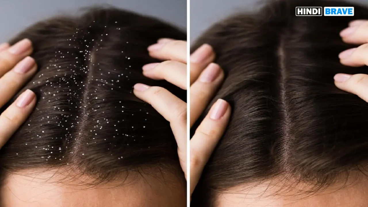 Causes and effective home remedies for dandruff